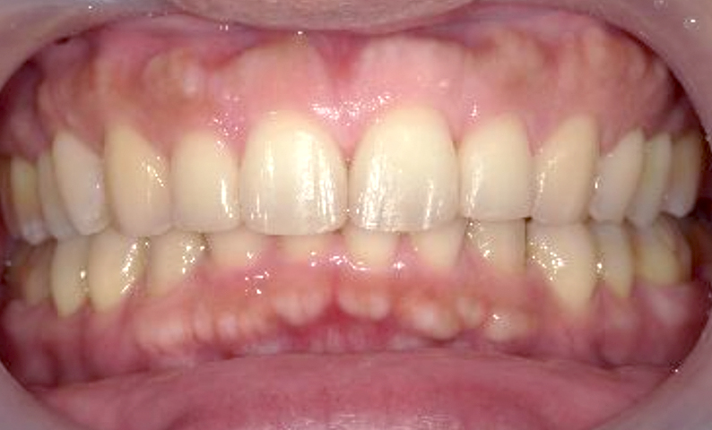 部分矯正 50代の症例写真