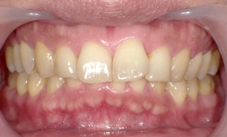 部分矯正 50代の症例写真