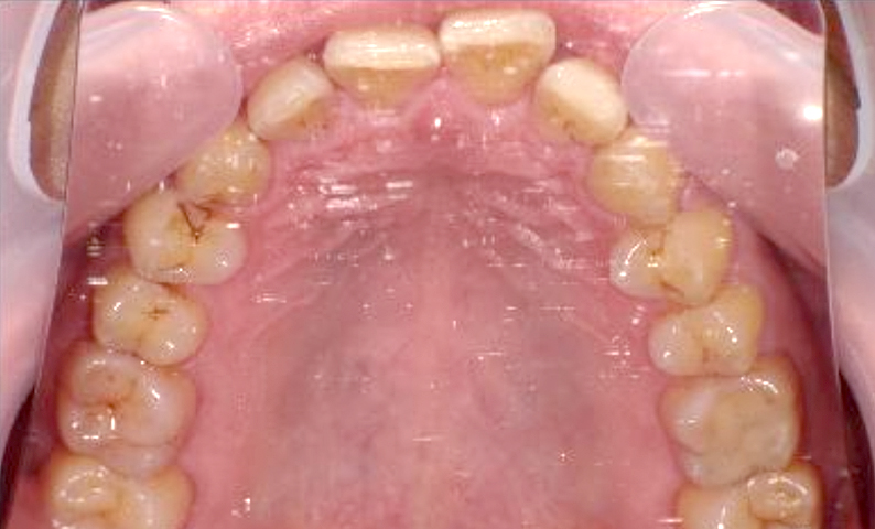 部分矯正 50代の症例写真