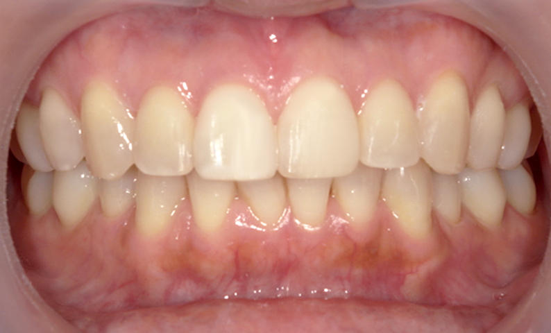 部分矯正 50代の症例写真