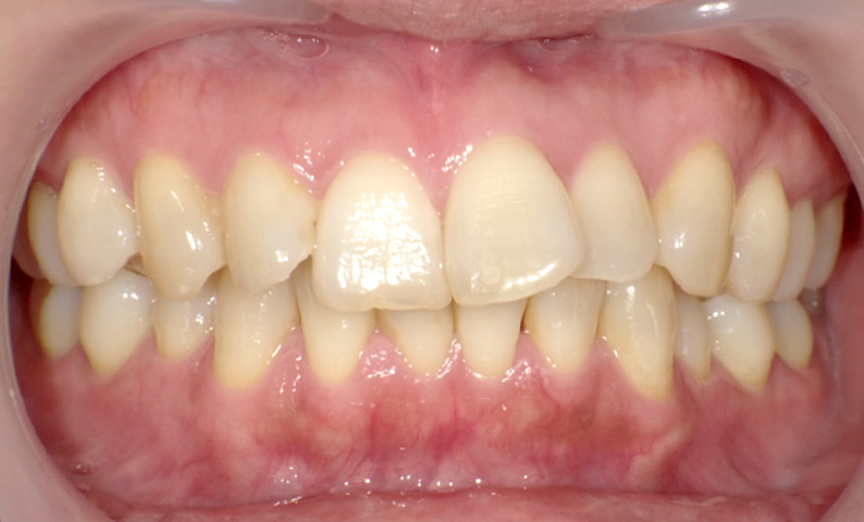 部分矯正 50代の症例写真