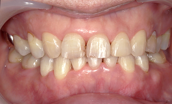 部分矯正 50代の症例写真