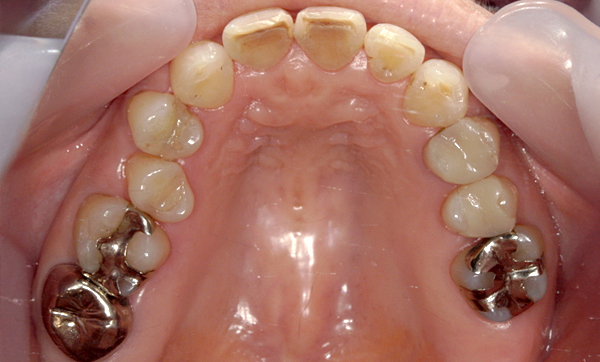 部分矯正 50代の症例写真