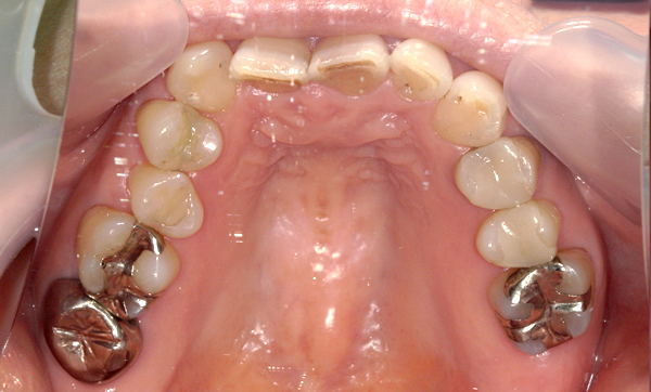 部分矯正 50代の症例写真