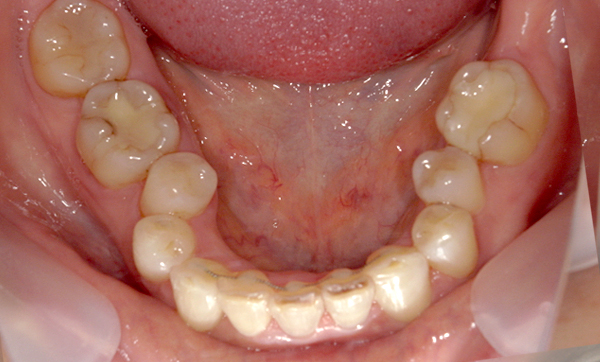 部分矯正 50代の症例写真