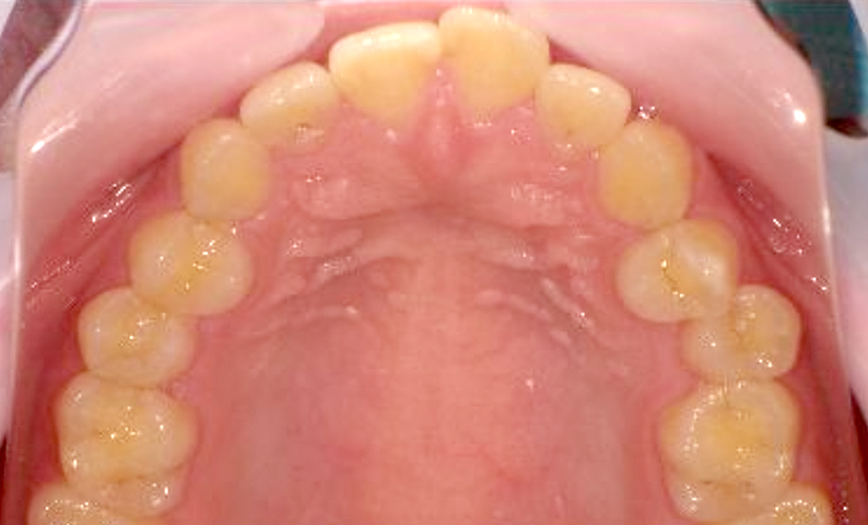 前歯のねじれ「捻転歯」部分矯正の症例集