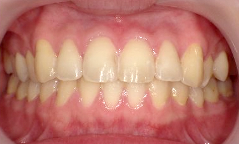 前歯のねじれ「捻転歯」部分矯正の症例集