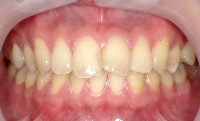 前歯のねじれ「捻転歯」部分矯正の症例集