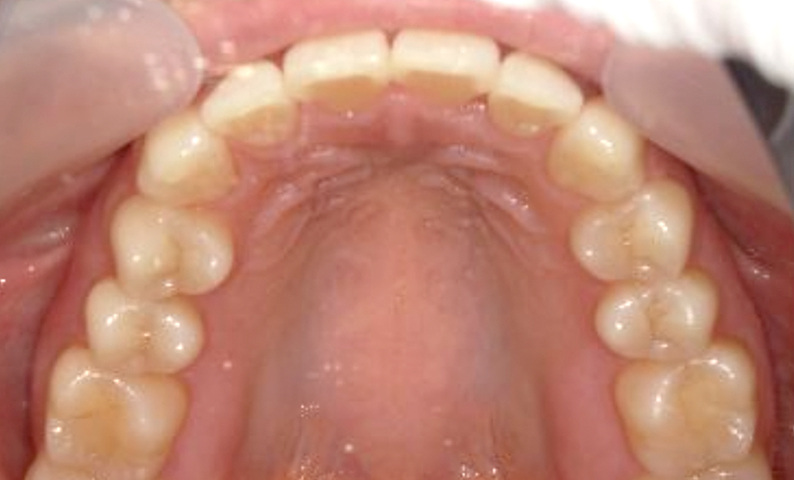 前歯のねじれ「捻転歯」部分矯正の症例集