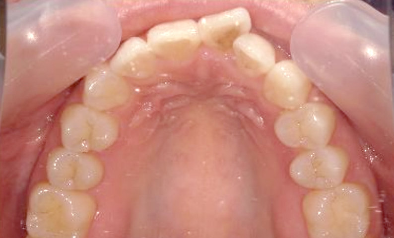 前歯のねじれ「捻転歯」部分矯正の症例集