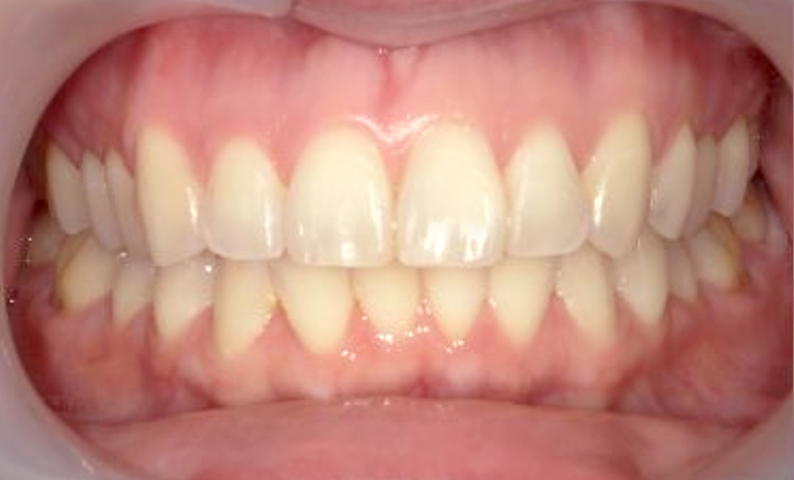 前歯のねじれ「捻転歯」部分矯正の症例集