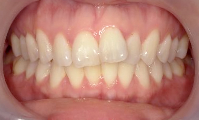 前歯のねじれ「捻転歯」部分矯正の症例集