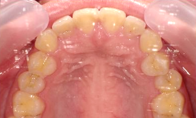 前歯のねじれ「捻転歯」部分矯正の症例集