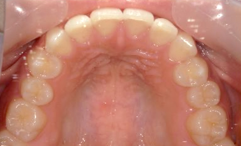 前歯のねじれ「捻転歯」部分矯正の症例集