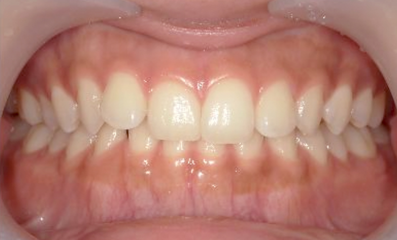 前歯のねじれ「捻転歯」部分矯正の症例集