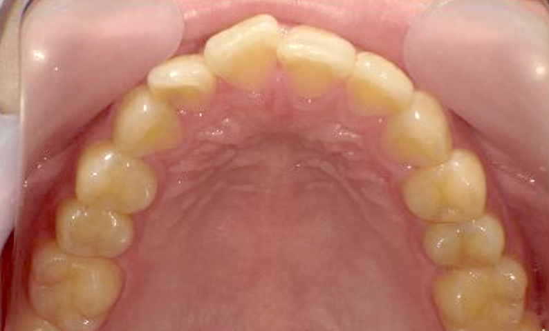 前歯のねじれ「捻転歯」部分矯正の症例集