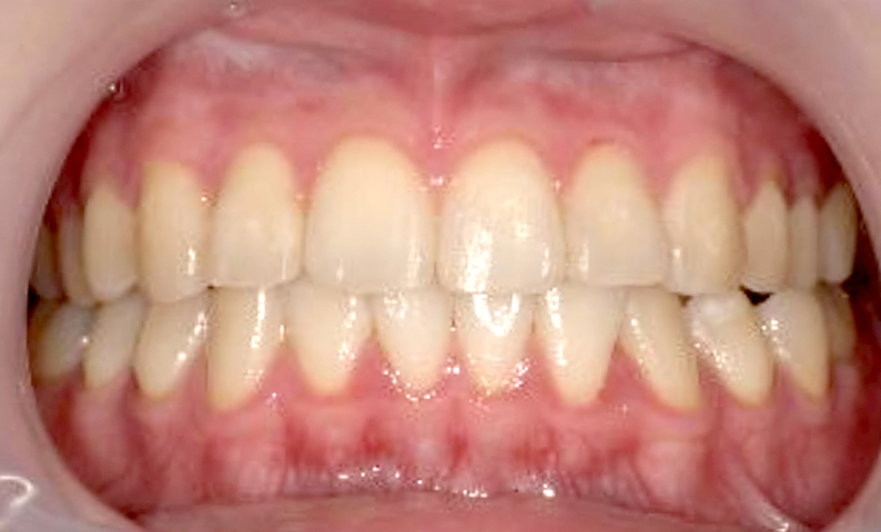 前歯のねじれ「捻転歯」部分矯正の症例集