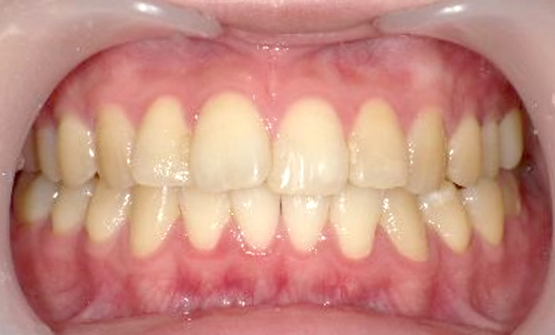 前歯のねじれ「捻転歯」部分矯正の症例集