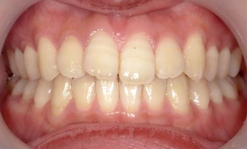 前歯のねじれ「捻転歯」部分矯正の症例集