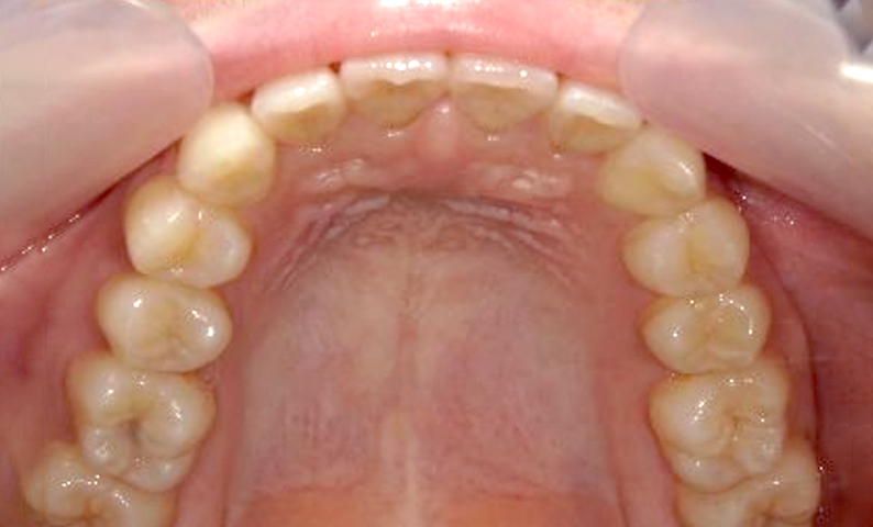 前歯のねじれ「捻転歯」部分矯正の症例集
