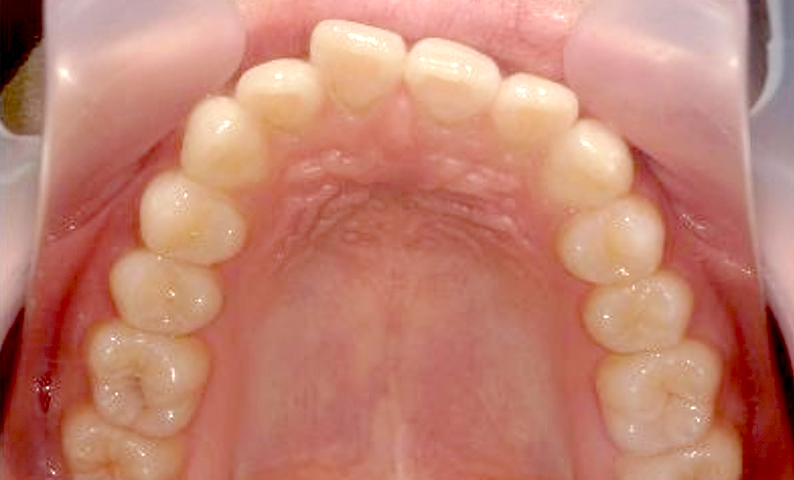 前歯のねじれ「捻転歯」部分矯正の症例集