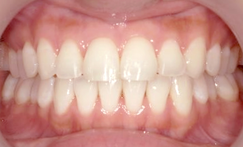 前歯のねじれ「捻転歯」部分矯正の症例集