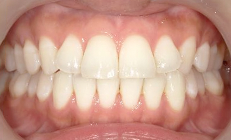 前歯のねじれ「捻転歯」部分矯正の症例集