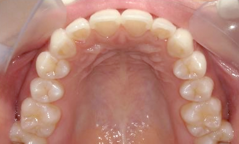 前歯のねじれ「捻転歯」部分矯正の症例集