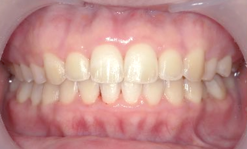 部分矯正 上下の部分矯正の症例写真