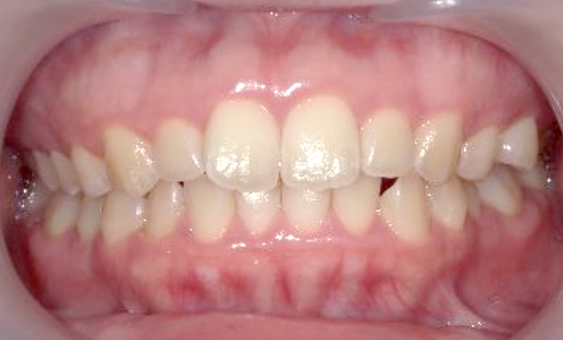 前歯のねじれ「捻転歯」部分矯正の症例集