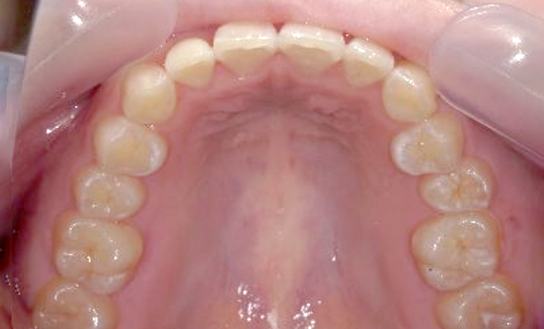前歯のねじれ「捻転歯」部分矯正の症例集