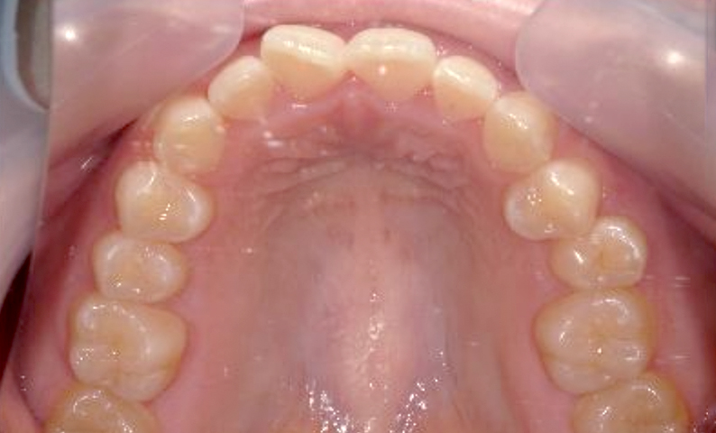 前歯のねじれ「捻転歯」部分矯正の症例集