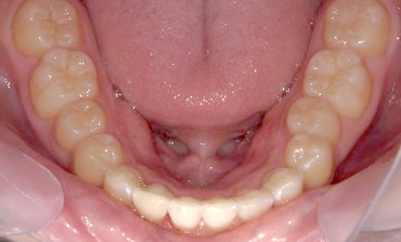 前歯のねじれ「捻転歯」部分矯正の症例集