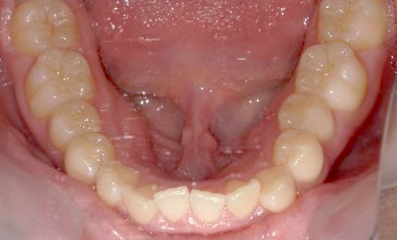 前歯のねじれ「捻転歯」部分矯正の症例集