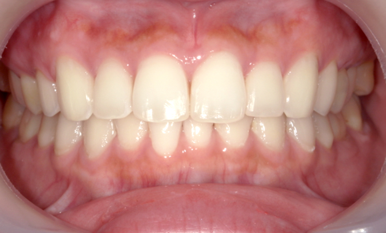 前歯のねじれ「捻転歯」部分矯正の症例集