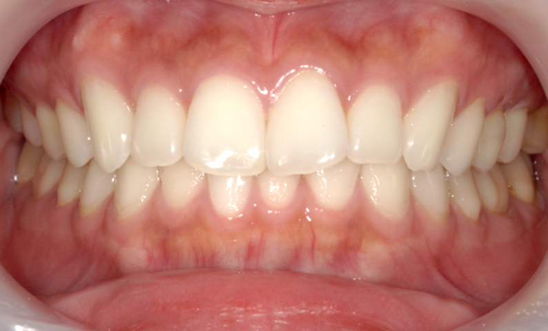 前歯のねじれ「捻転歯」部分矯正の症例集