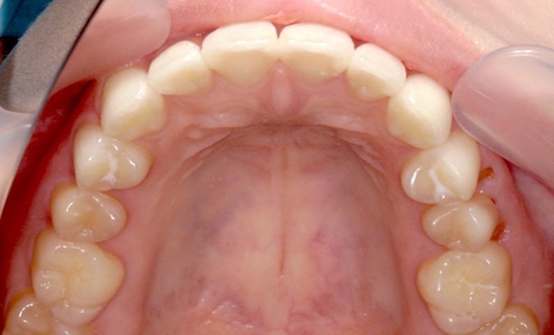 前歯のねじれ「捻転歯」部分矯正の症例集