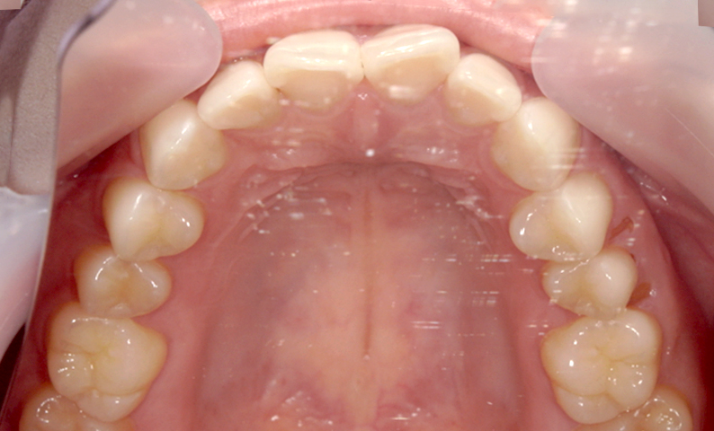 前歯のねじれ「捻転歯」部分矯正の症例集