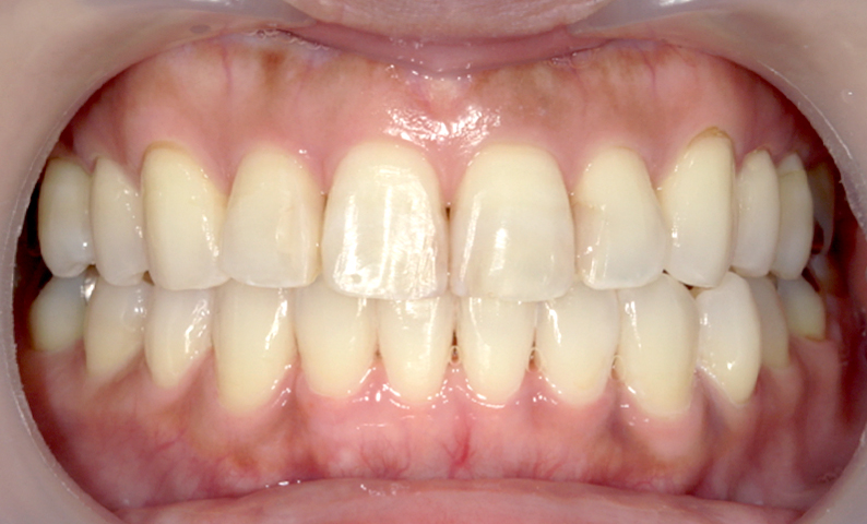 前歯のねじれ「捻転歯」部分矯正の症例集