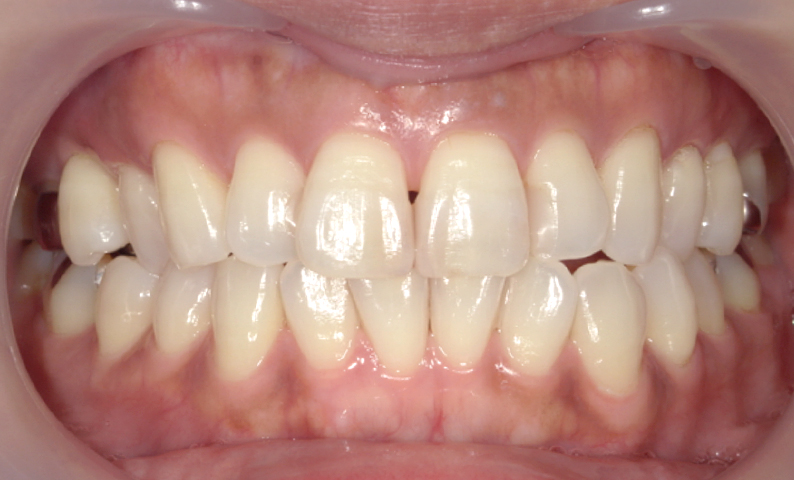 前歯のねじれ「捻転歯」部分矯正の症例集