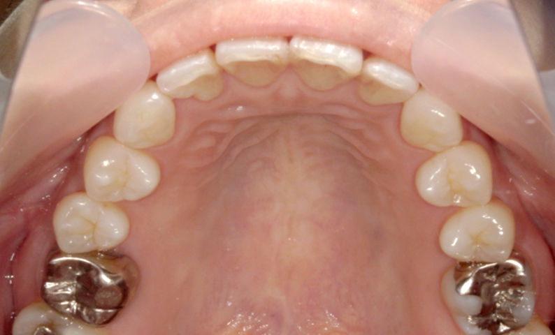 前歯のねじれ「捻転歯」部分矯正の症例集