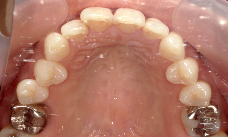 前歯のねじれ「捻転歯」部分矯正の症例集