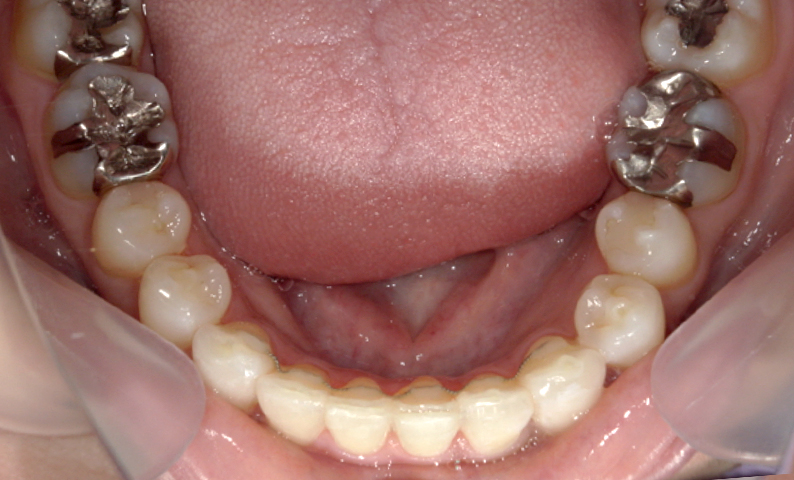 前歯のねじれ「捻転歯」部分矯正の症例集