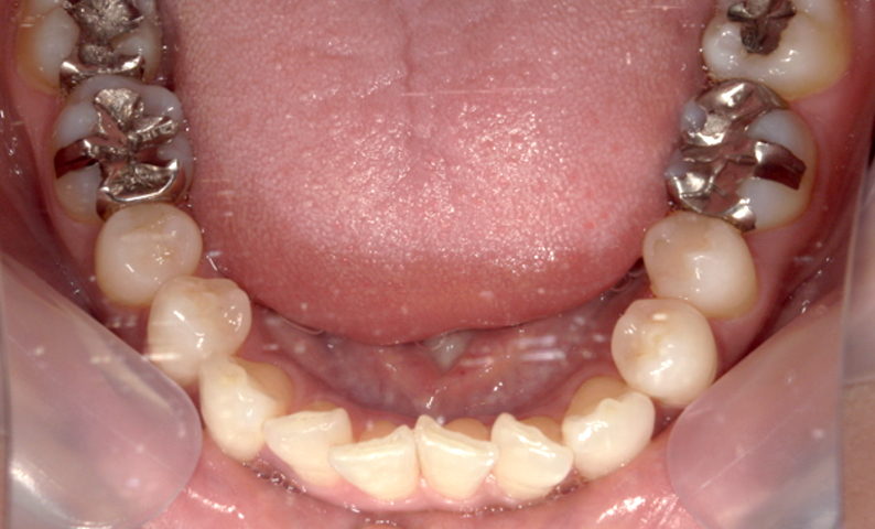 前歯のねじれ「捻転歯」部分矯正の症例集