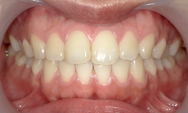 前歯のねじれ「捻転歯」部分矯正の症例集