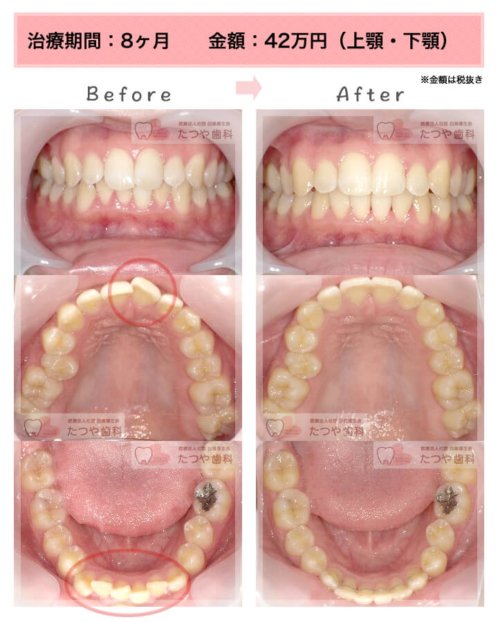 部分矯正の症例　前歯「少しのねじれ」