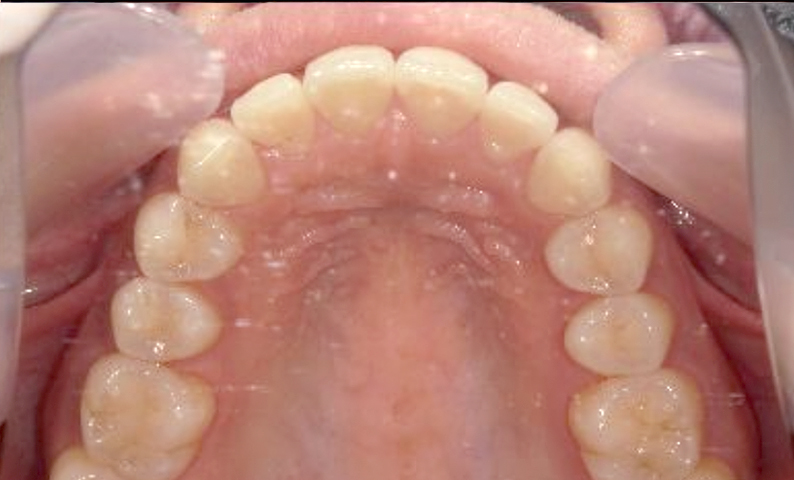 部分矯正 出っ歯の部分矯正の症例写真