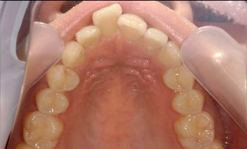 部分矯正 出っ歯の部分矯正の症例写真