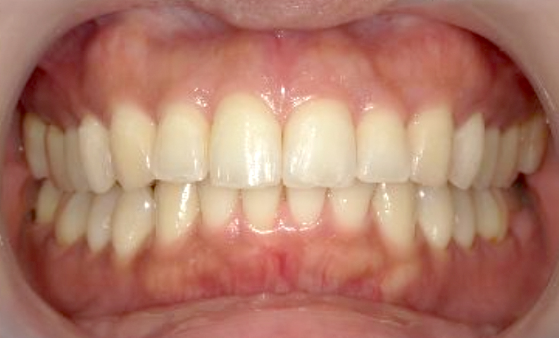 部分矯正 出っ歯の部分矯正の症例写真