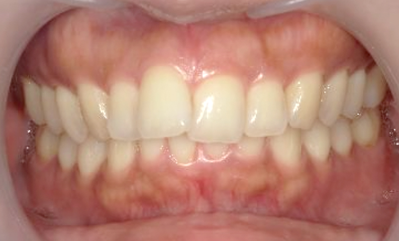 部分矯正 出っ歯の部分矯正の症例写真